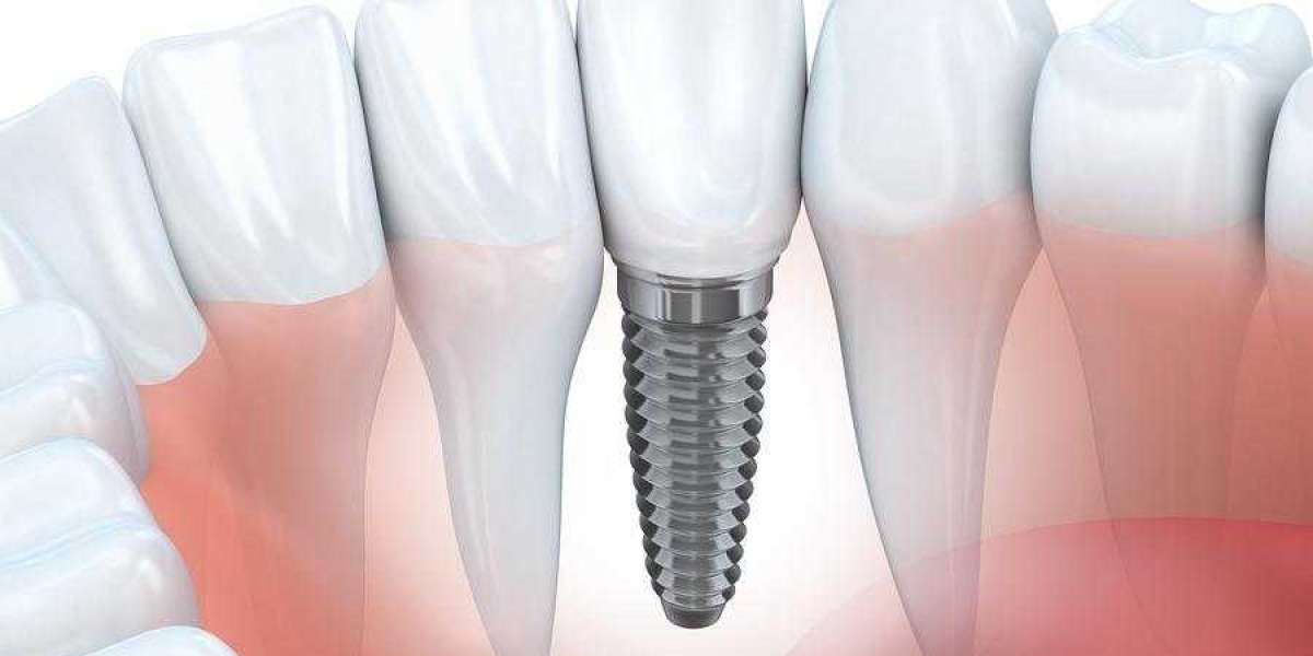 Dental Implants in Queens: Restoring Your Confidence and Oral Health